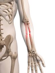 Orthopedic Trauma Implants – Plates, Nails & Screws